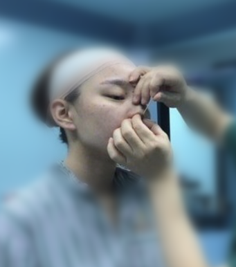 重庆肋软骨鼻部手术案利分享