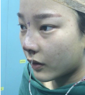 重庆肋软骨鼻部手术案利分享