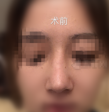 上海隆鼻失败第三次修复术后一个月果分享