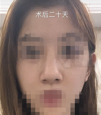 上海隆鼻失败第三次修复术后一个月果分享