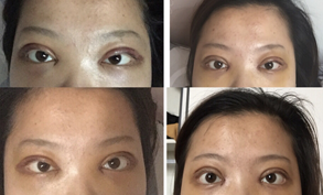岳阳爱思特全切眼部手术大半年了，很自然哦