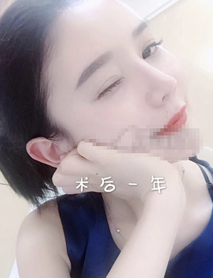 成都做的肋软骨隆鼻部手术修复一年分享~