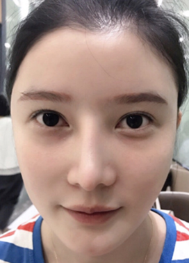成都做的肋软骨隆鼻部手术修复一年分享~