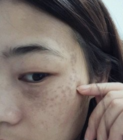 重庆激光去太田痣第一次调节1个多月了