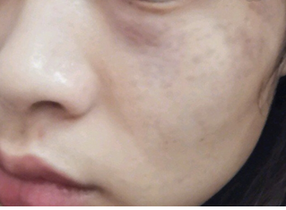重庆激光去太田痣第一次调节1个多月了