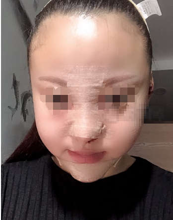 郑州自软骨鼻部手术+垫下巴+面部吸脂术后分享