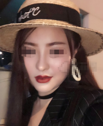 郑州自软骨鼻部手术+垫下巴+面部吸脂术后分享