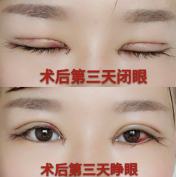 在合肥立新做了全切双眼皮眼部手术手术分享