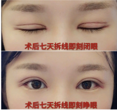 在合肥立新做了全切双眼皮眼部手术手术分享