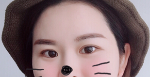 整形医院做的双眼皮眼部手术案例分享