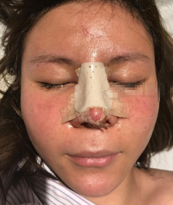 宁波美莱做了自体软骨鼻部手术案例分享