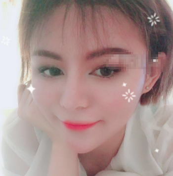 宁波美莱做了自体软骨鼻部手术案例分享