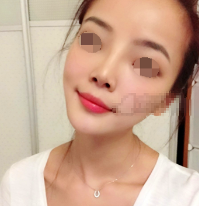 北京上上相庞东亮做脂肪填充怎么样?