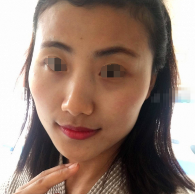 成都友谊医院李继华医生磨骨怎么样?