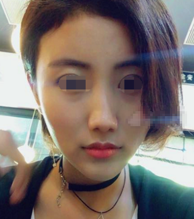 成都友谊医院李继华医生磨骨怎么样?