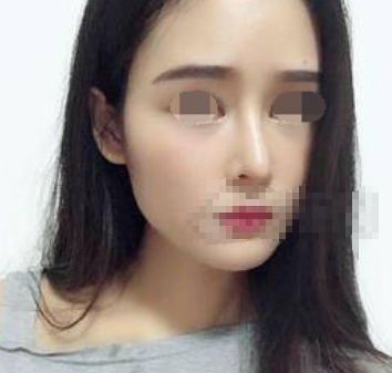 北京玉之光王明利面部脂肪填充怎么样?