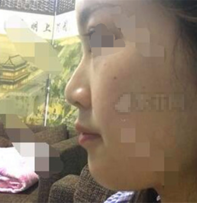 上海九院戴传昌隆鼻怎么样?