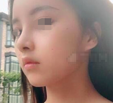 上海九院戴传昌隆鼻怎么样?