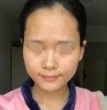 北京玉之光王明利面部脂肪填充怎么样?
