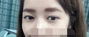 成都莱尹刘辅容做双眼皮修复价格 有负面吗?