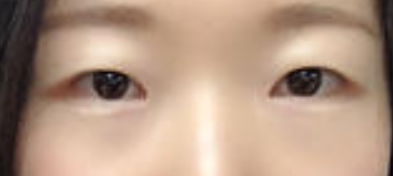上海九院余力医生做大腿吸脂怎么样?