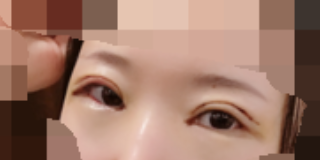 上海九院余力医生做大腿吸脂怎么样?