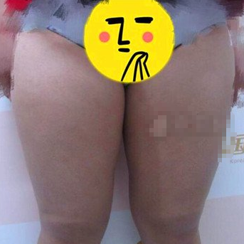 上海九院曹卫刚吸脂有负面吗 价格表?