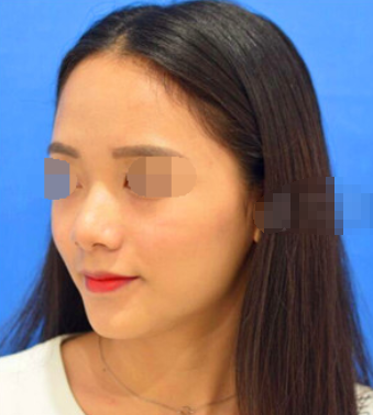 成都心悦容徐航、倪志云隆鼻怎么样 负面多吗?