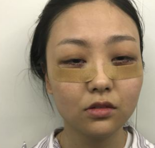 上海华美整形许再荣眼袋外切怎么样?