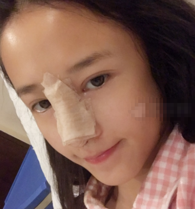 鼻尖延长罗汇东医生做的怎么样?