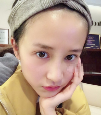 鼻尖延长罗汇东医生做的怎么样?