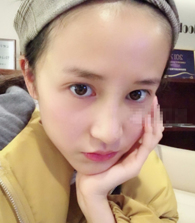 鼻尖延长罗汇东医生做的怎么样?