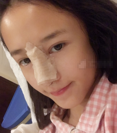 鼻尖延长罗汇东医生做的怎么样?