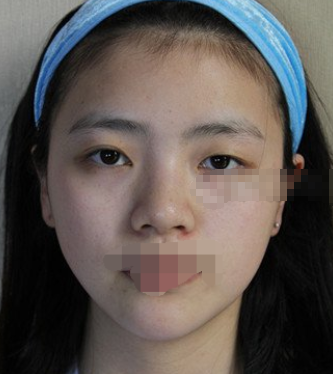 北京同仁韩勋双眼皮做的怎么样 失败案例有吗?
