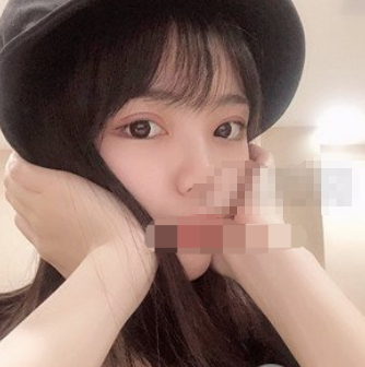 北京同仁韩勋双眼皮做的怎么样 失败案例有吗?