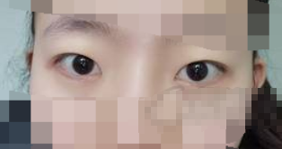 成都华西郭文祥郭爷爷割双眼皮怎么样 多少钱?