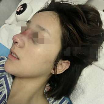 成都西区医院邓东伟隆鼻怎么样 案例负面有吗?