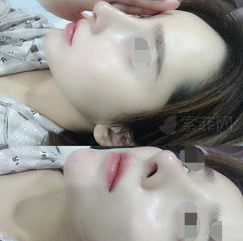 成都西区医院邓东伟隆鼻怎么样 案例负面有吗?
