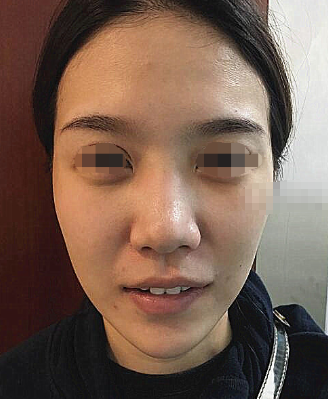 罗汇东王军隆鼻谁好,多少钱?