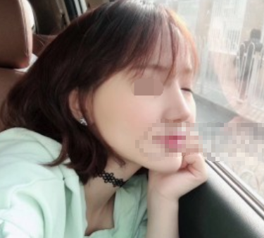 四川娇点李竞鼻部手术案例