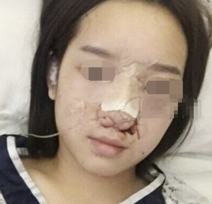 上海容妍李昕鼻部手术怎么样?