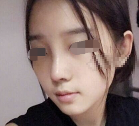 上海容妍李昕鼻部手术怎么样?