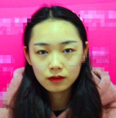 大连何医生何栋良双眼皮做的怎么样?