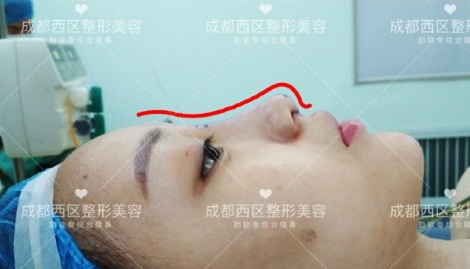 成都西区医院邓东伟 车红昌做鼻子怎么样?