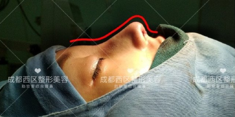 成都西区医院邓东伟 车红昌做鼻子怎么样?