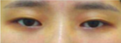 成都美极双眼皮庄建波医生怎么样？