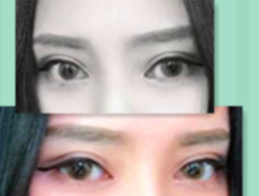 成都美极双眼皮庄建波医生怎么样？