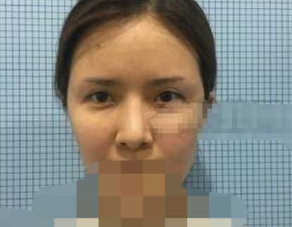 江苏省中医院陈刚医生隆鼻怎么样,有案例吗?