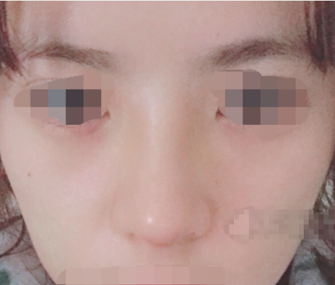 上海九院肖开颜隆鼻怎么样,有案例吗?
