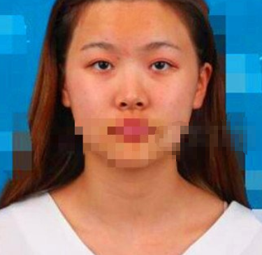 深圳罗湖协同李本龙眼部手术怎么样,有案例吗?